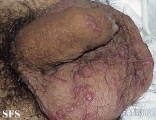 scabies