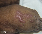 scabies