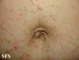 scabies