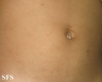 scabies