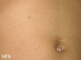 scabies