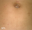 scabies