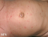scabies