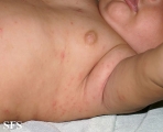 scabies