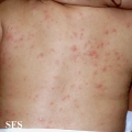 scabies