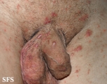 scabies