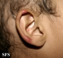 scabies