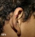 scabies