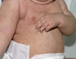 scabies