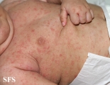 scabies