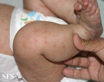 scabies