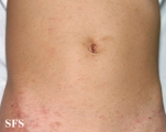 scabies