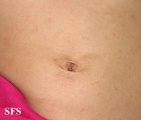 scabies