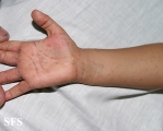 scabies