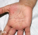 scabies