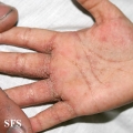 scabies