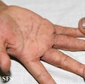 scabies