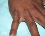 scabies