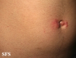 scabies
