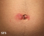 scabies