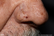 basal_cell_carcinoma_and_sebaceous_gland_hyperplasia