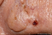 basal_cell_carcinoma_and_sebaceous_gland_hyperplasia