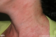 pityriasis rosea