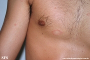 pityriasis rosea