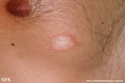 pityriasis rosea