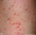 pityriasis rosea