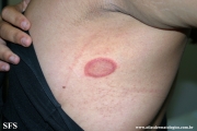 pityriasis rosea