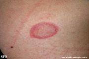 pityriasis rosea