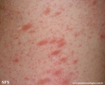 pityriasis rosea