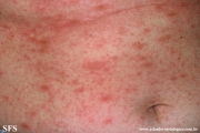 pityriasis rosea
