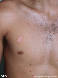 pityriasis rosea
