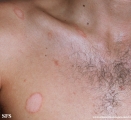 pityriasis rosea