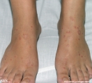 pityriasis rosea