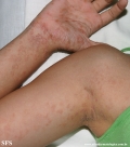 pityriasis rosea