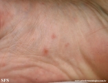 pityriasis rosea