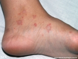 pityriasis rosea
