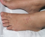 pityriasis rosea