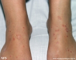 pityriasis rosea