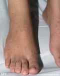 pityriasis rosea