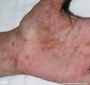 pityriasis rosea
