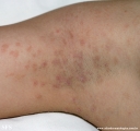 pityriasis rosea