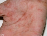 pityriasis rosea