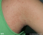 pityriasis rosea