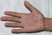 pityriasis rosea