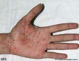 pityriasis rosea