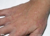 pityriasis rosea